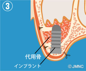 サイナスリフトの説明図