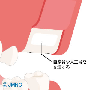 GBR（骨誘導再生法）の説明図